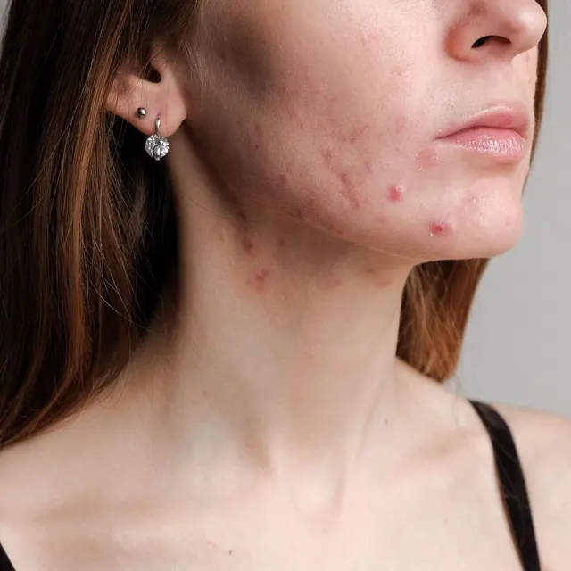 Close-up of inflamed acne along a woman’s jaw and cheek