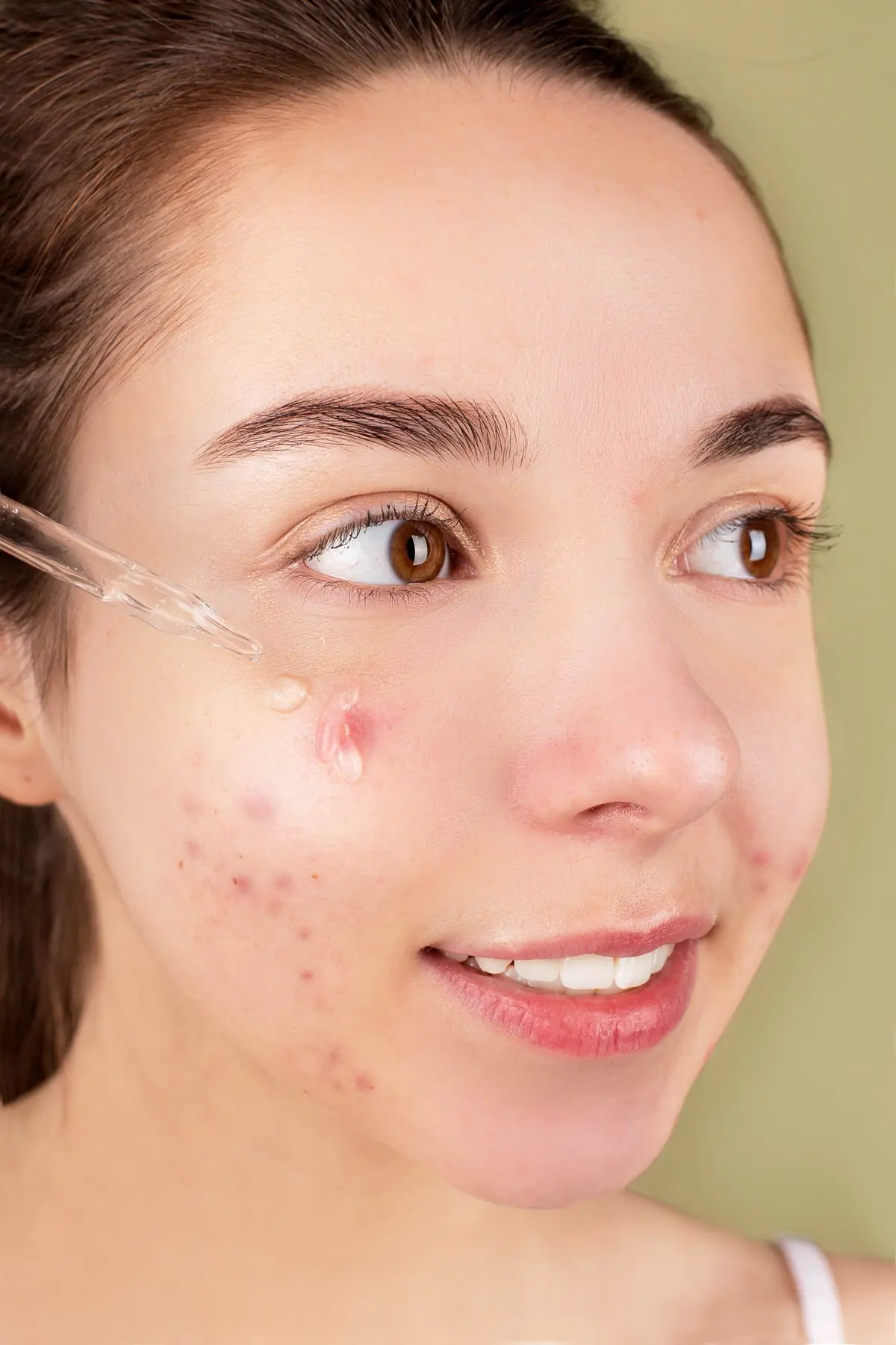 Young woman with acne patches on her cheek
