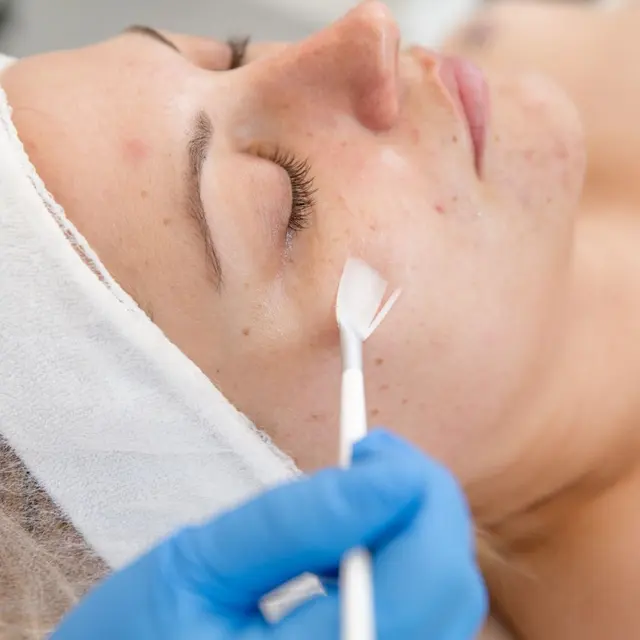 Esthetician brushing a chemical peel solution onto a patient’s face