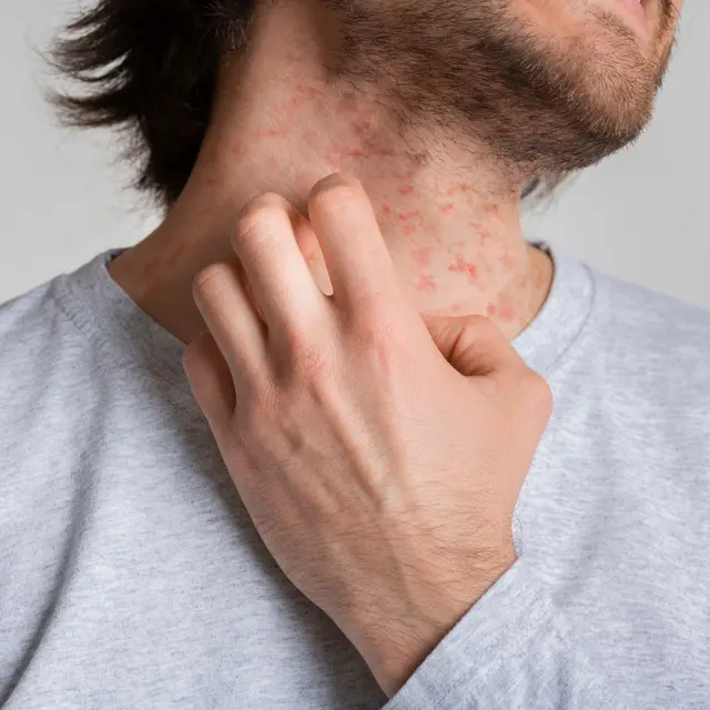 Man scratching an itchy red eczema patch on his neck