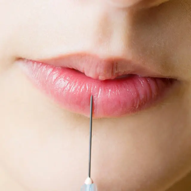 Fine needle placing filler at the edge of the lips