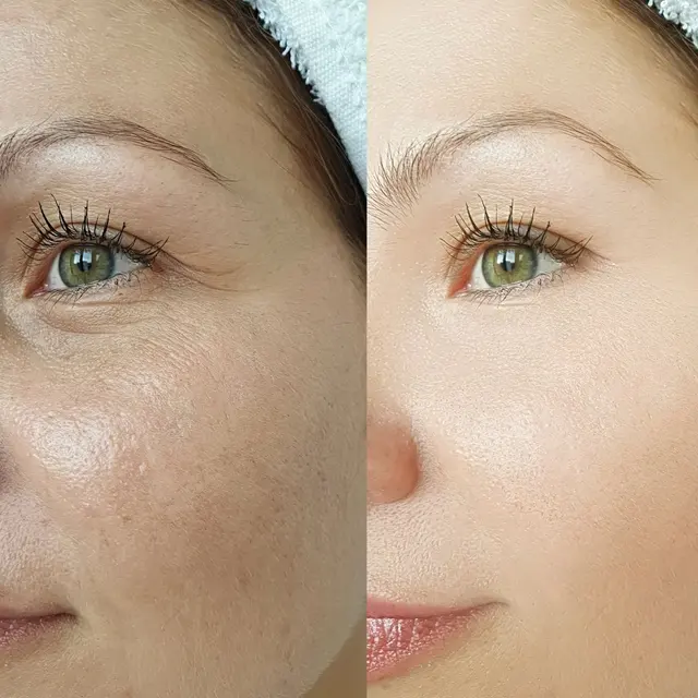 Side-by-side close-up comparing uneven and even skin tone