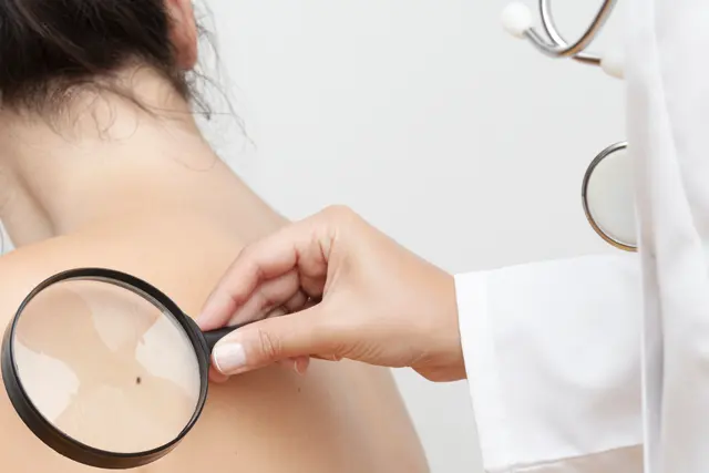 Dermatologist checking a mole on a patient’s back with a dermatoscope