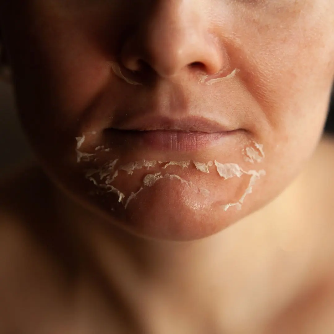 Dry, peeling skin around the chin