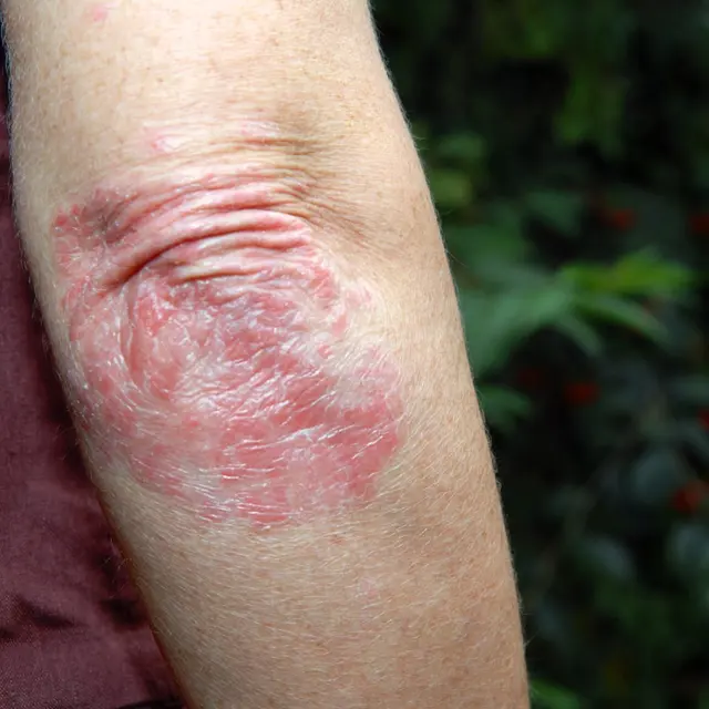 Raised, scaly psoriasis plaque on an elbow