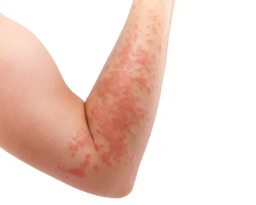 Red, itchy rash spreading across a forearm