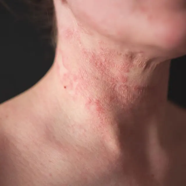 Red, irritated contact rash on the side of a neck