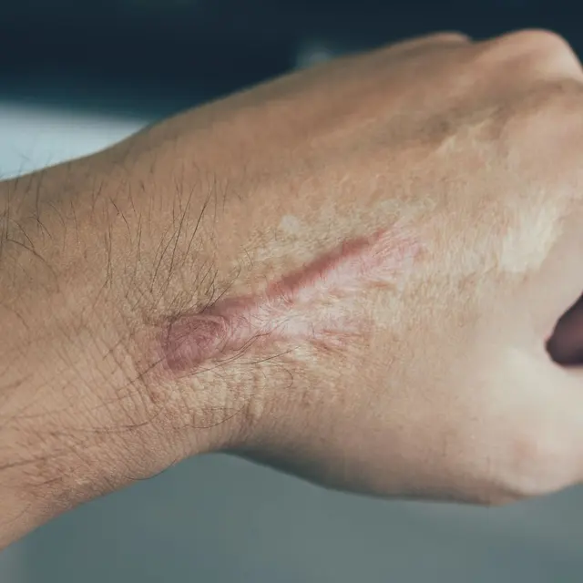 Healed surgical scar on the back of a hand and wrist