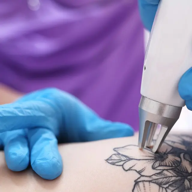 Laser handpiece treating a black-ink tattoo