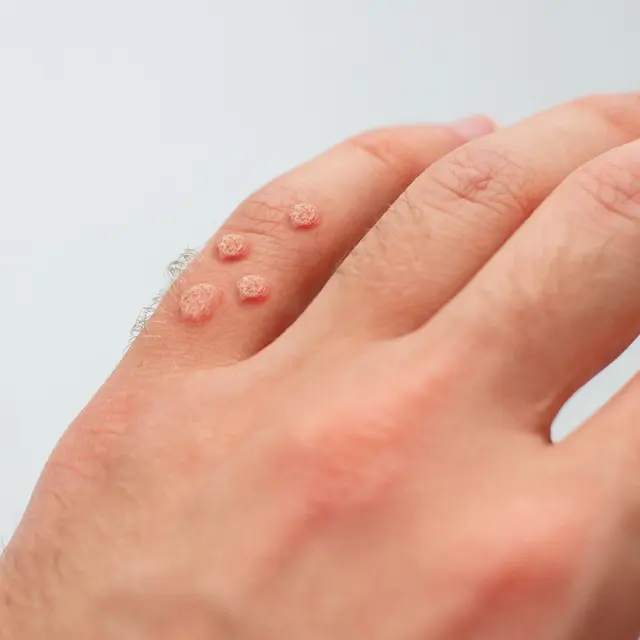 Several common warts on the back of a hand